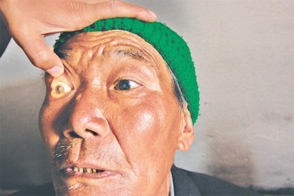 03102015085416eye2 600x0