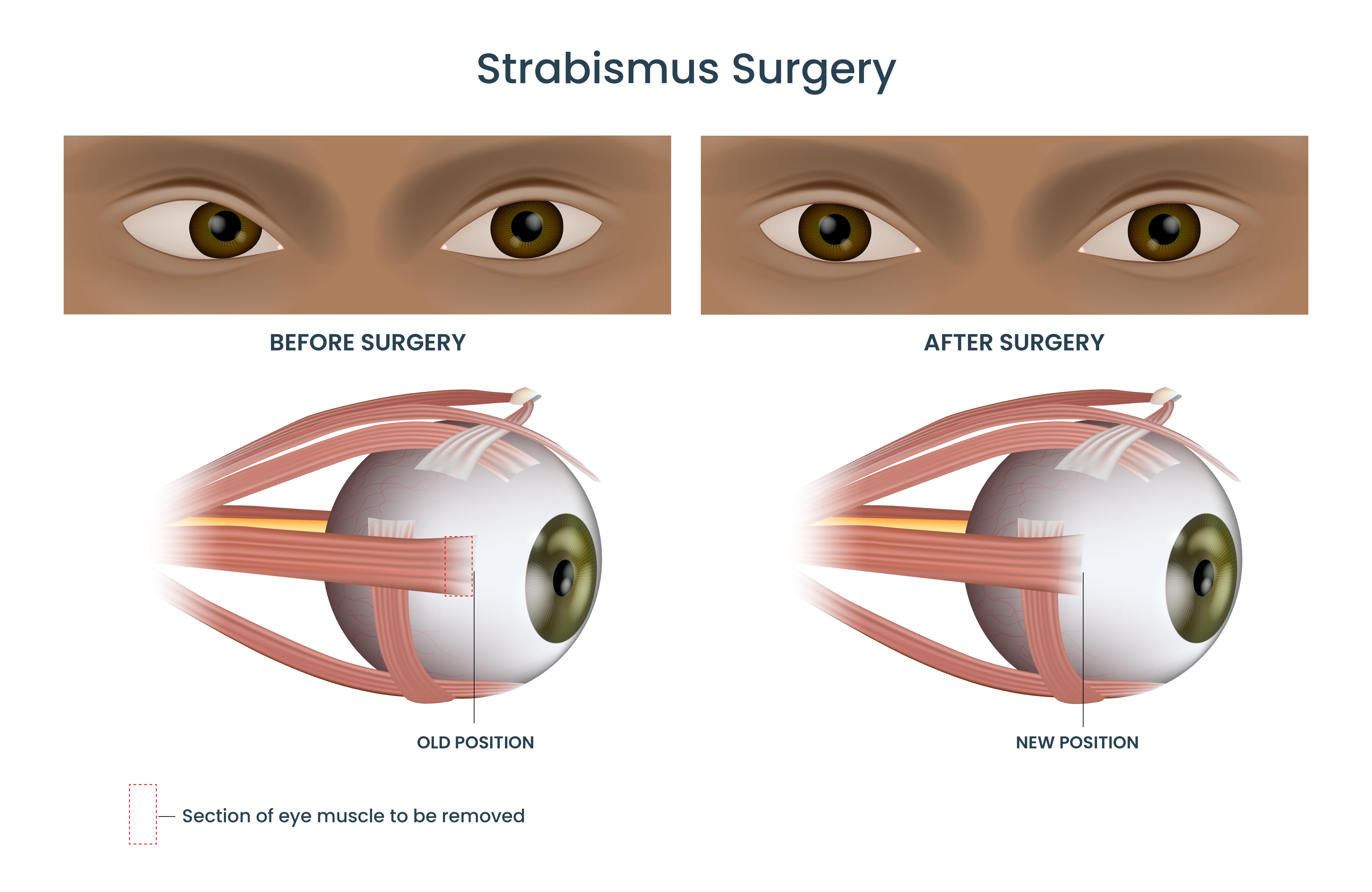 Strabismus surgery