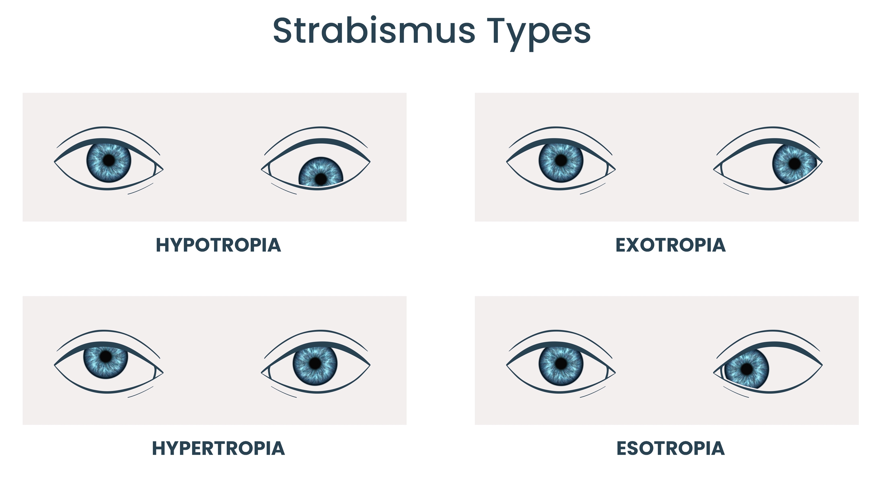 Strabismus types